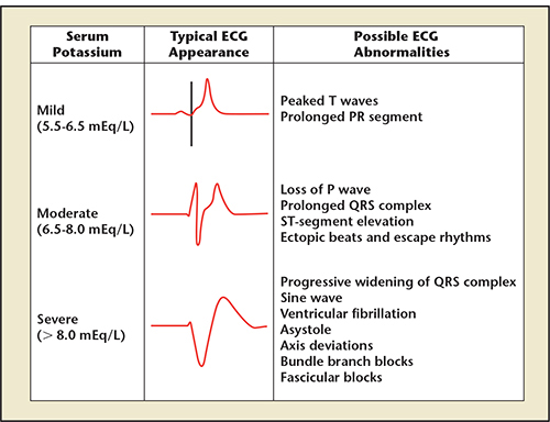 ecg signs of hyperkalemia
