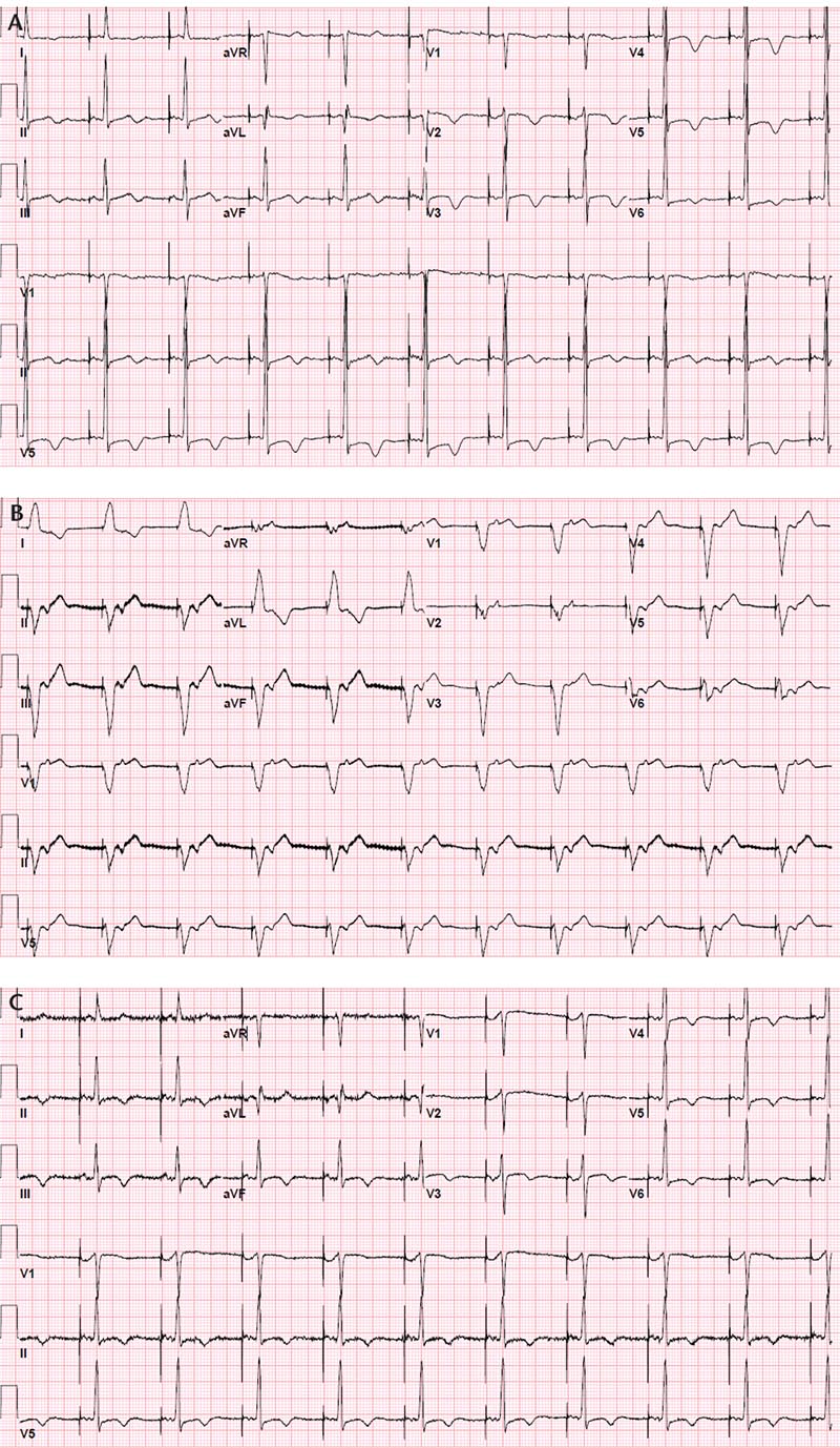 Echo image of right ventricular apex (RVA) pacemaker, pressure