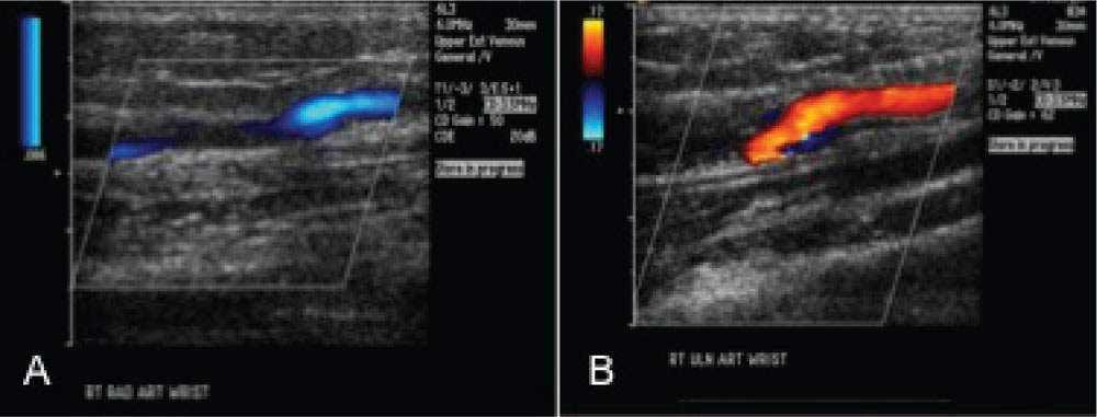 Vascular Complications of Percutaneous Transradial Cardiac Catheterization