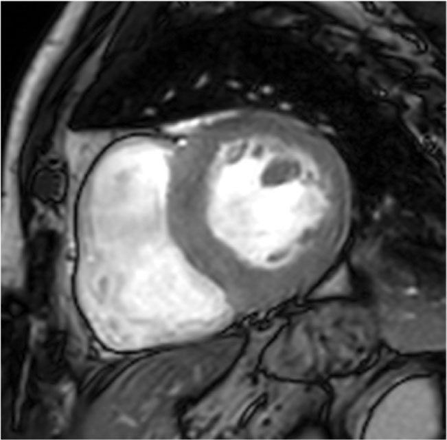 The Role Of Cardiac Magnetic Resonance Imaging In Hypertrophic Cardiomyopathy 4441