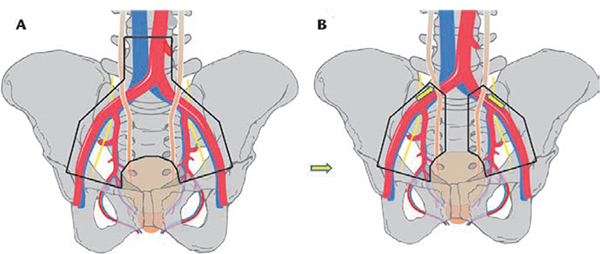 Extent of Pelvic Lymph Node Dissection During Radical Cystectomy: Is