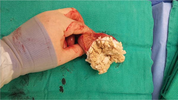 cyst epidermoid testicle testicular torsion contents debris right keratinous caseous urology