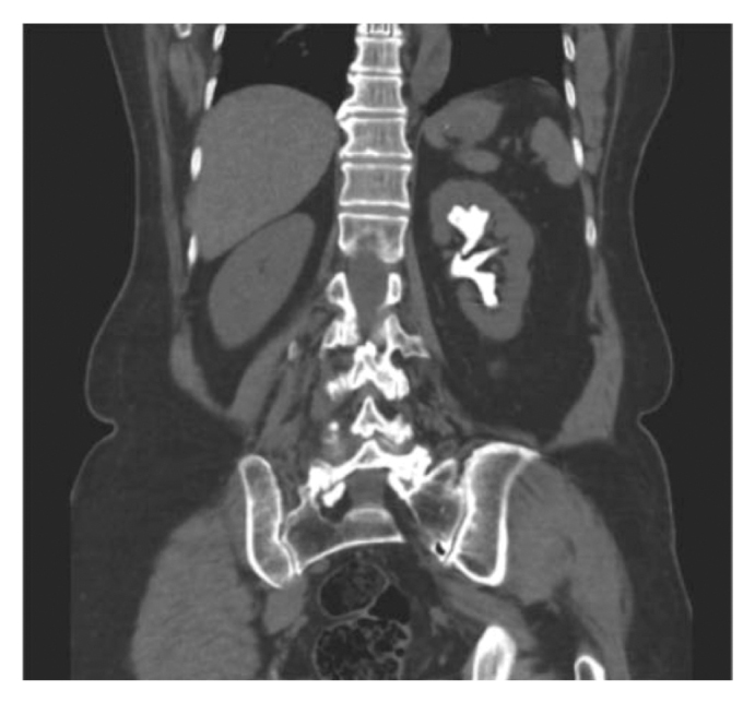 Staghorn Calculi in a Woman With Recurrent Urinary Tract Infections