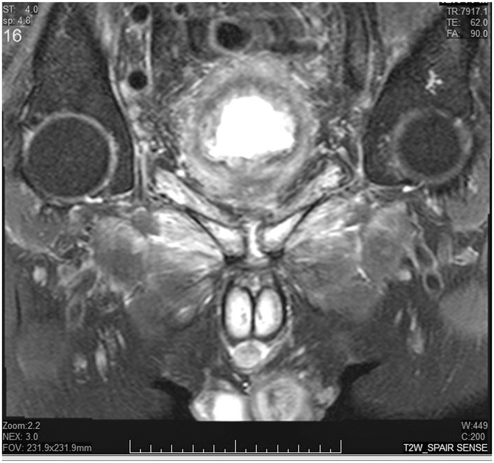 Osteitis Pubis: A Rare Cause of Suprapubic Pain