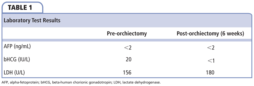 Primary Retroperitoneal Lymph Node Dissection for Stage IB Nonseminomatous  Germ Cell Tumor